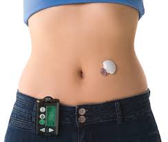 Continuous blood glucose monitor used in COCO90s clinic